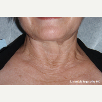 Neck Wrinkles Erased with PRP Injections before 1857287