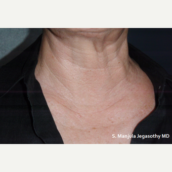 Neck Wrinkles Erased with PRP Injections after 1857287