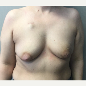 35 year old woman treated with Breast Reconstruction before 3401270