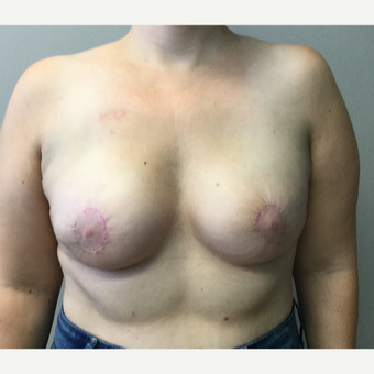 35 year old woman treated with Breast Reconstruction after 3401270