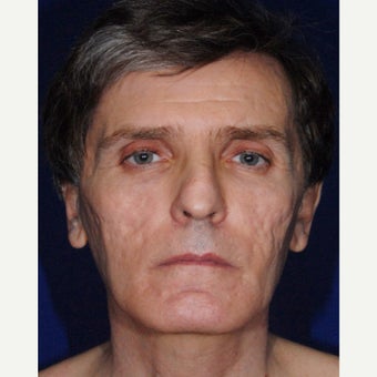 35-44 year old man treated with Bellafill before 2450372