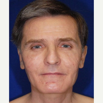 35-44 year old man treated with Bellafill after 2450372