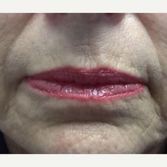 65-74 year old woman treated with Restylane Silk before 1831330