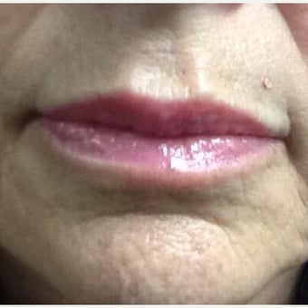 65-74 year old woman treated with Restylane Silk after 1831330