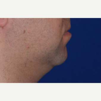 25-34 year old man treated with Chin Liposuction before 3638178