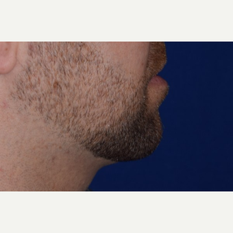 25-34 year old man treated with Chin Liposuction after 3638178
