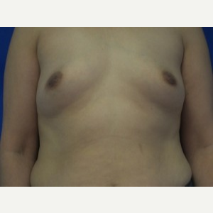 Breast Augmentation before 3054754