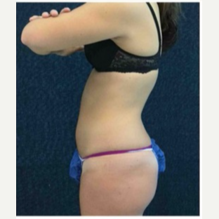 18-24 year old woman treated with CoolSculpting after 3181794