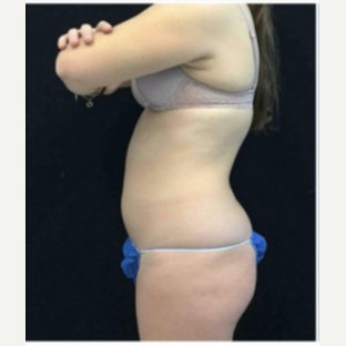 18-24 year old woman treated with CoolSculpting before 3181794