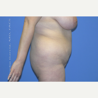 45-54 year old woman treated with Body Lift-Circumferential "Belt" lipectomy + Vaser Liposuction before 3041532