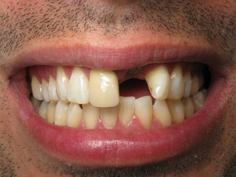 Crown Replacement & Implant Crown Before & After Photo before 996262
