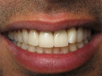 Crown Replacement & Implant Crown Before & After Photo after 996262