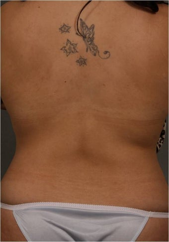 28 Year Old Female requesting non surgical treatment of her bra roll with CoolSculpting after 1369482