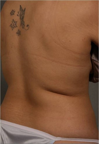 28 Year Old Female requesting non surgical treatment of her bra roll with CoolSculpting 1369482