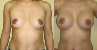 Breast Augmentation before 1323351