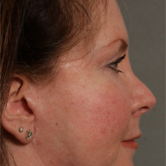45-54 year old woman treated with Revision Rhinoplasty before 3208200