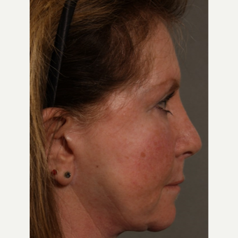 45-54 year old woman treated with Revision Rhinoplasty after 3208200