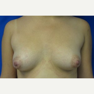 Breast Augmentation before 3054761