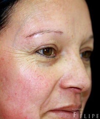 35-44 year old woman treated with Chemical Peel before 3417679