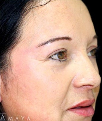 35-44 year old woman treated with Chemical Peel after 3417679