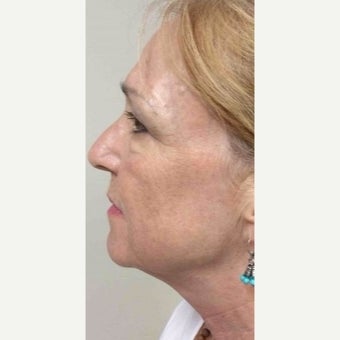 55-64 year old woman treated with Fraxel Laser after 2372868