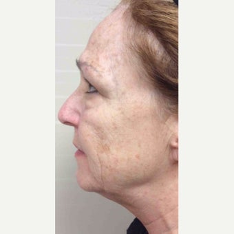 55-64 year old woman treated with Fraxel Laser before 2372868