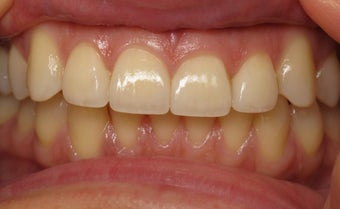 Veneers Before & After Photo after 996261