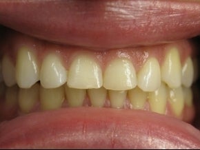 Veneers Before & After Photo before 996261