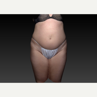 35-44 year old woman treated with Smart Lipo before 3803859