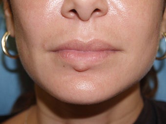 Extensive repair of scarring and deformity as a result of silicone and BioPolymer lip injections before 695976