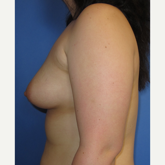 18-24 year old woman treated with Breast Augmentation (360cc) before 3247453