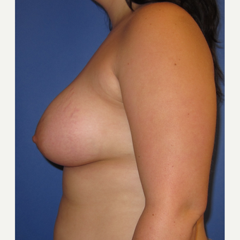18-24 year old woman treated with Breast Augmentation (360cc) after 3247453