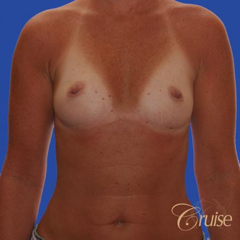 37 year old woman treated with Saline Breast Implants before 3833248