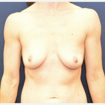 55-64 year old woman treated with Breast Augmentation before 3726829