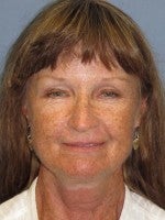 65-74 year old woman treated with Neck Lift before 3103909