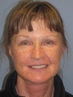 65-74 year old woman treated with Neck Lift after 3103909