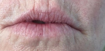 45-54 year old woman treated with Belotero before 2361064