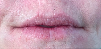 45-54 year old woman treated with Belotero after 2361064