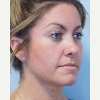 25-34 year old woman treated with Revision Rhinoplasty after 3686781