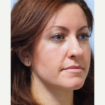 25-34 year old woman treated with Revision Rhinoplasty before 3686781