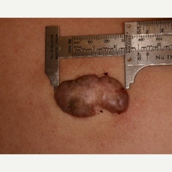 Large keloid treated with Cannula + Cryotherapy two cycles - 29 year old Asian man before 1735838