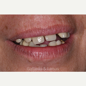55-64 year old woman treated with All-on-4 Dental Implants before 2884727