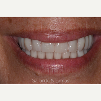 55-64 year old woman treated with All-on-4 Dental Implants after 2884727