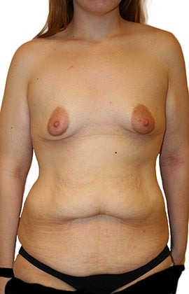 Lower Body lift, Breast Augmentation before 543105