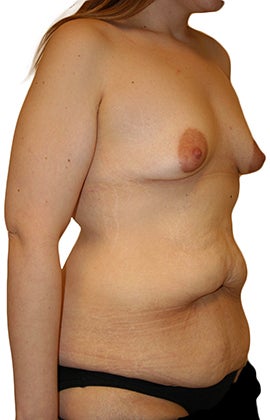Lower Body lift, Breast Augmentation 543105