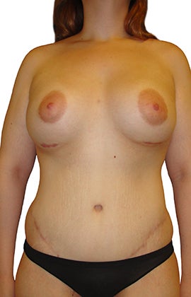 Lower Body lift, Breast Augmentation after 543105