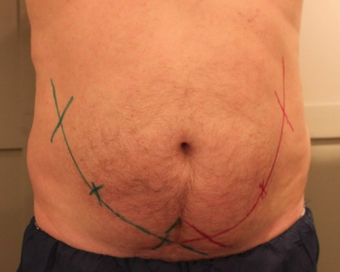 Early 50s Man CoolSculpting 1397322