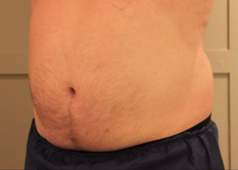 Early 50s Man CoolSculpting after 1397322