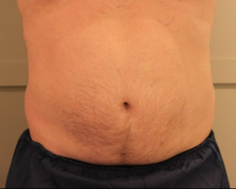 Early 50s Man CoolSculpting 1397322