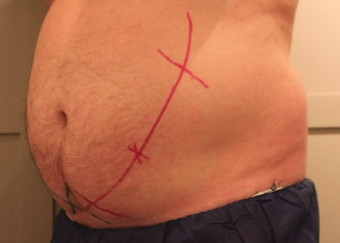 Early 50s Man CoolSculpting before 1397322